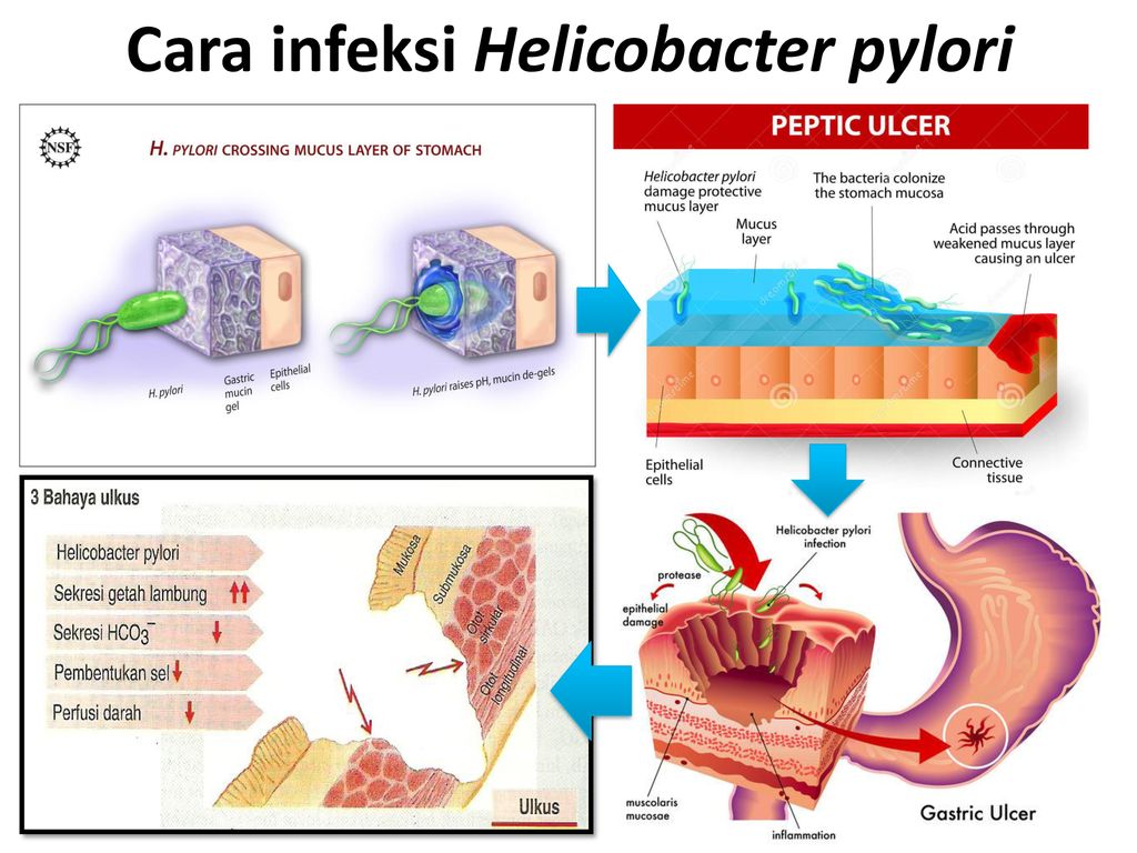 Tengo helicobacter pylori puedo contagiar a mi familia